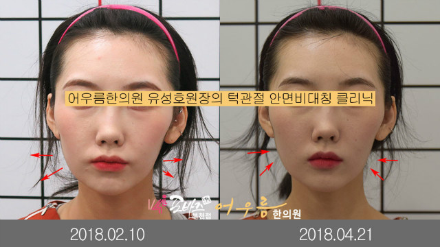 Daum 카페 어우름한의원 > 공지사항 > 턱관절 안면비대칭 치료사례 사진, 동영상(2018.10.15업뎃)” style=”width:100%” title=”어우름한의원 > 공지사항 > 턱관절 안면비대칭 치료사례 사진, 동영상(2018.10.15업뎃)” loading=”lazy”><figcaption>어우름한의원 > 공지사항 > 턱관절 안면비대칭 치료사례 사진, 동영상(2018.10.15업뎃)</figcaption></figure>
<figure><img decoding=